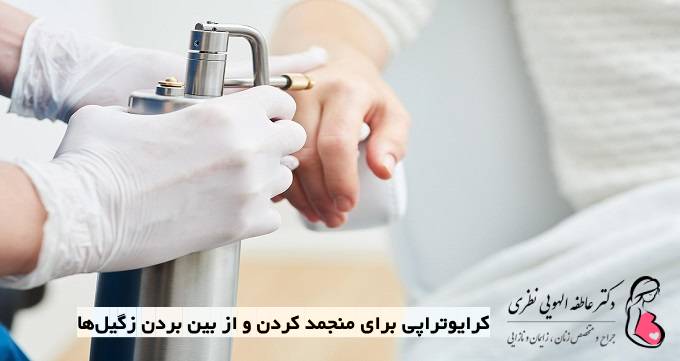 کرایوتراپی برای منجمد کردن و از بین بردن زگیل‌ها